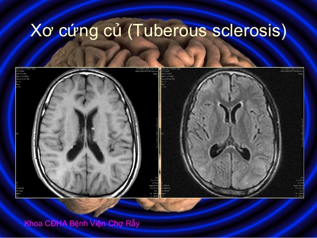Xơ cứng củ - Hình ảnh minh họa